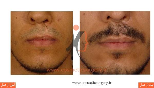 جراحی و ترمیم شکاف لب و کام