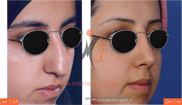 عمل جراحی انحراف بینی