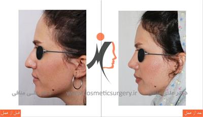 nouse cosmetic surgery 3