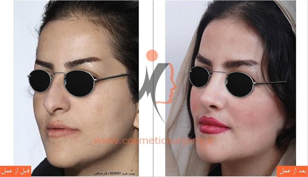 جراحی زیبایی بینی