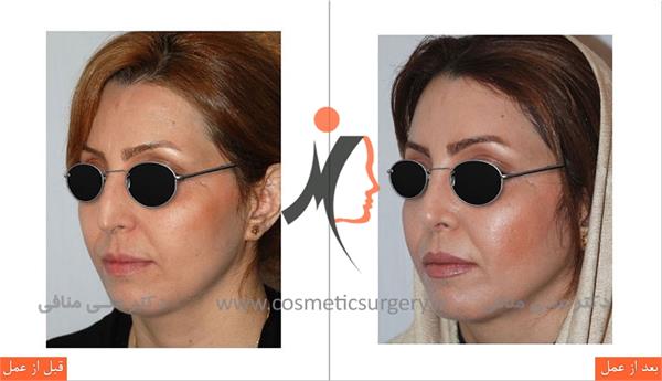 عمل جراحی زیبایی بینی 1