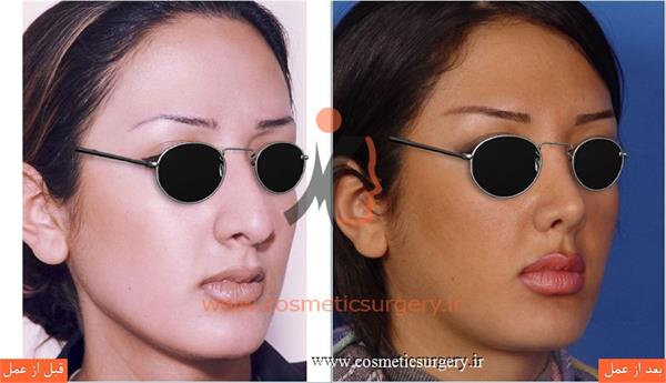 جراحی زیبایی بینی