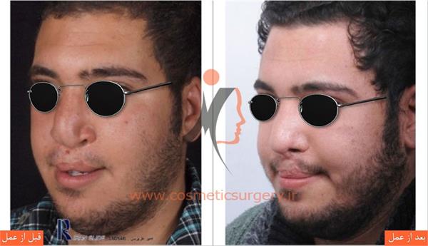 جراحی زیبایی بینی در بیماران شکاف لب و کام