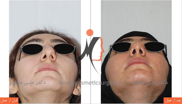 nouse cosmetic surgery