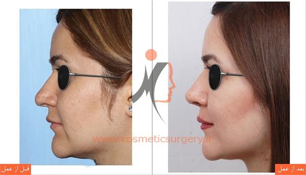 جراحی زیبایی بینی  4
