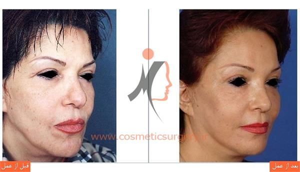 لیفت کامل صورت به همراه جوان سازی دور چشم