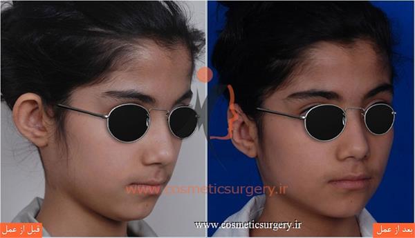 جراحی گوش ( ترمیم گوش برجسته )