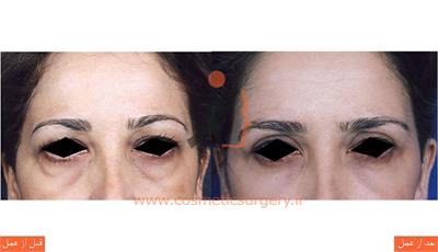 جراحی پلک بالا و پایین