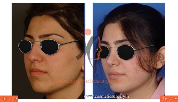 جراحی زیبایی بینی