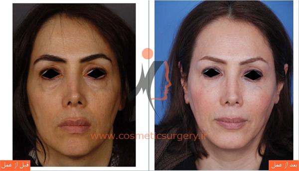 جراحی پلک به همراه جلو آوردن چانه و تزریق چربی گونه