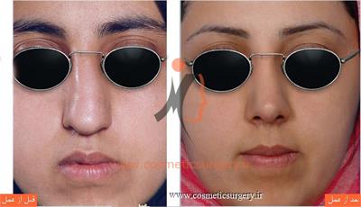 عمل جراحی انحراف بینی