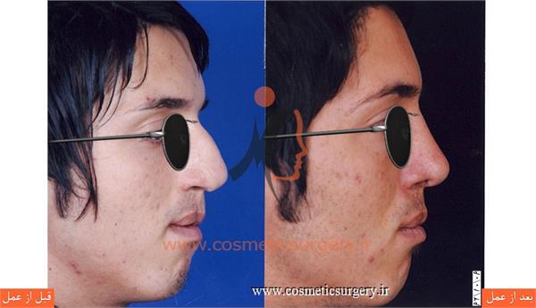 جراحی زیبایی بینی به همراه ترمیم شکاف لب و کام