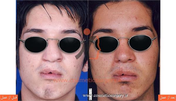 جراحی زیبایی بینی به همراه ترمیم شکاف لب و کام