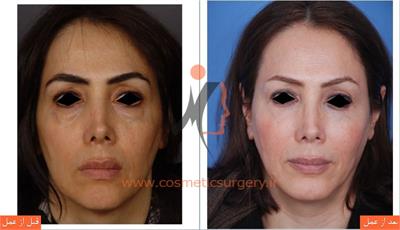 جراحی پلک به همراه جلو آوردن چانه و تزریق چربی گونه