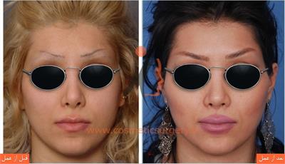 ترمیم بینی عمل شده توسط جراحان دیگر به همراه بلندتر کردن بینی و افزایش تناسب بینی