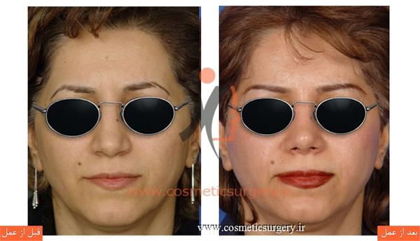 جراحی زیبایی بینی