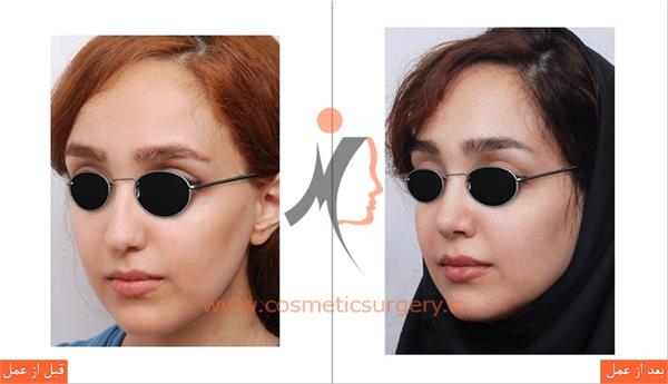جراحی زیبایی بینی 1