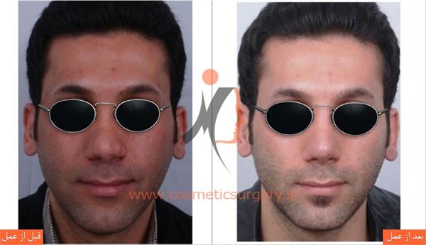 ترمیم بینی در بیماری که قبلا توسط جراحان دیگری عمل شده است