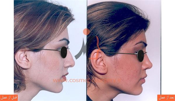 جراحی زیبایی بینی