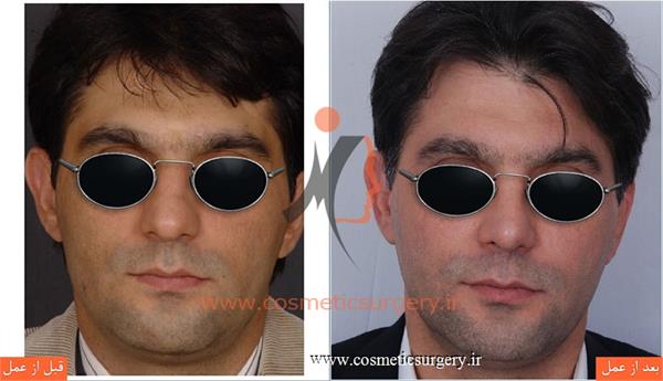 عمل جراحی انحراف بینی