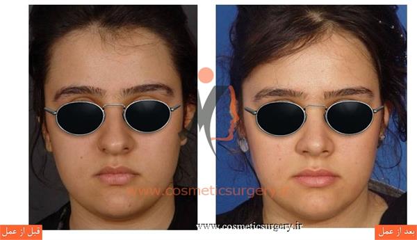 جراحی زیبایی بینی