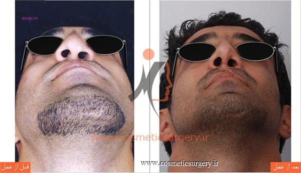 جراحی زیبایی بینی به همراه ترمیم شکاف لب و کام