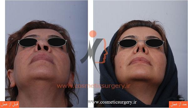 ترمیم بینی در بیماری که قبلا توسط جراحان دیگری عمل شده است