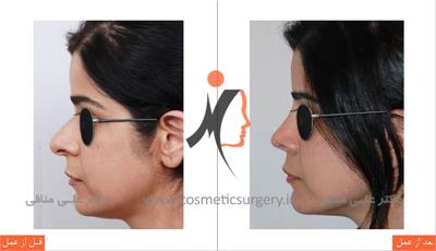 nose plastic surgery