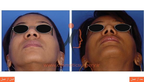 Broiler nose surgery1