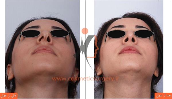 عمل جراحی انحراف بینی