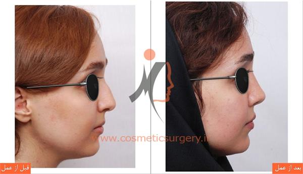 جراحی زیبایی بینی 5