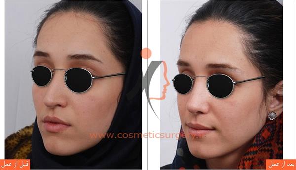 جراحی زیبایی بینی