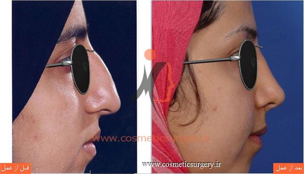 عمل جراحی انحراف بینی