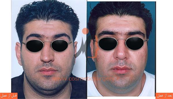 عمل جراحی انحراف بینی