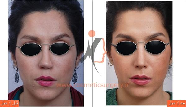 ترمیم بینی عمل شده توسط جراحان دیگر ( عمل بینی ثانویه )
