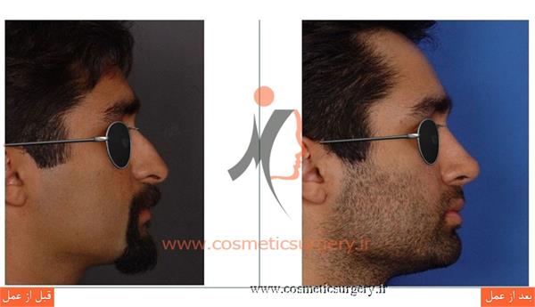 جراحی زیبایی بینی