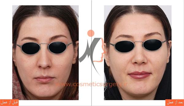 جراحی زیبایی بینی و تزریق چربی 3
