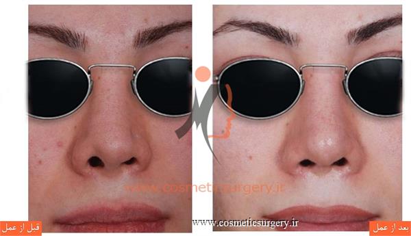 ترمیم بینی در بیماری که قبلا توسط جراحان دیگری عمل شده است