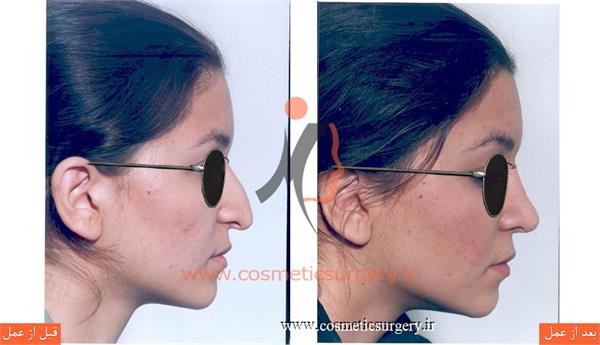 عمل جراحی انحراف بینی