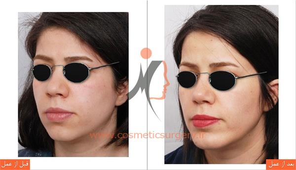 جراحی چانه 3