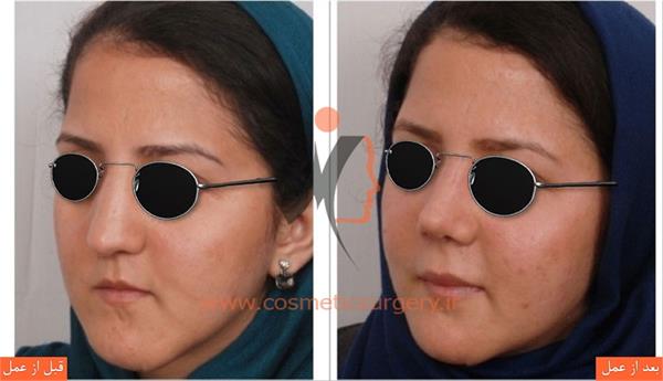 ترمیم بینی عمل شده توسط جراحان دیگر به همراه تزریق چربی و جراحی فک