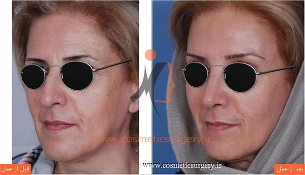 جراحی زیبایی بینی به همراه لیفت ابرو