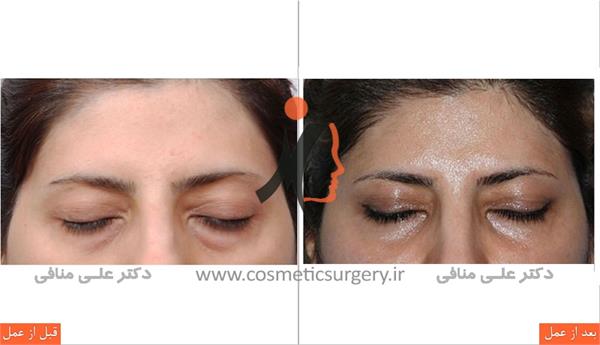 Eyelid surgery 1