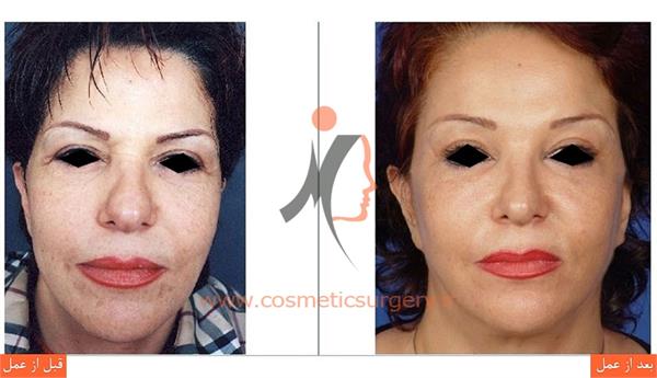 لیفت کامل صورت به همراه جوان سازی دور چشم