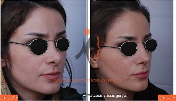 ترمیم بینی در بیماری که قبلا توسط جراحان دیگری عمل شده است