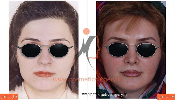 جراحی زیبایی بینی به همراه تزریق چربی