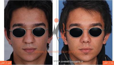 عمل جراحی بینی گوشتی