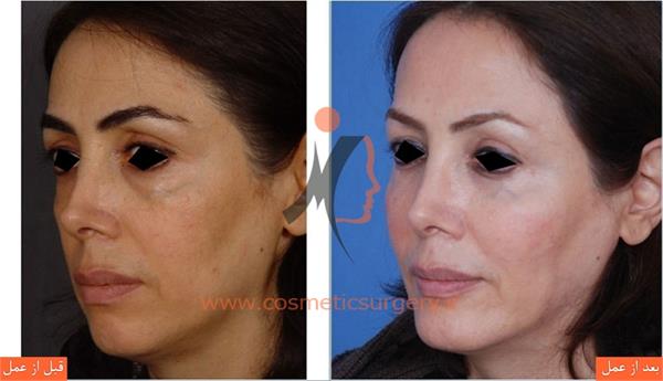 جراحی پلک به همراه جلو آوردن چانه و تزریق چربی گونه