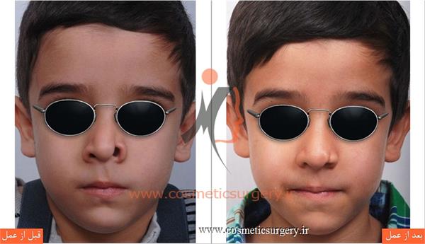ترمیم نقص مادر زادی بینی