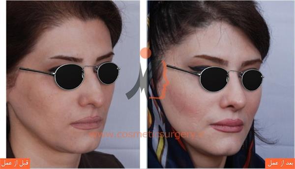 جراحی زیبایی بینی